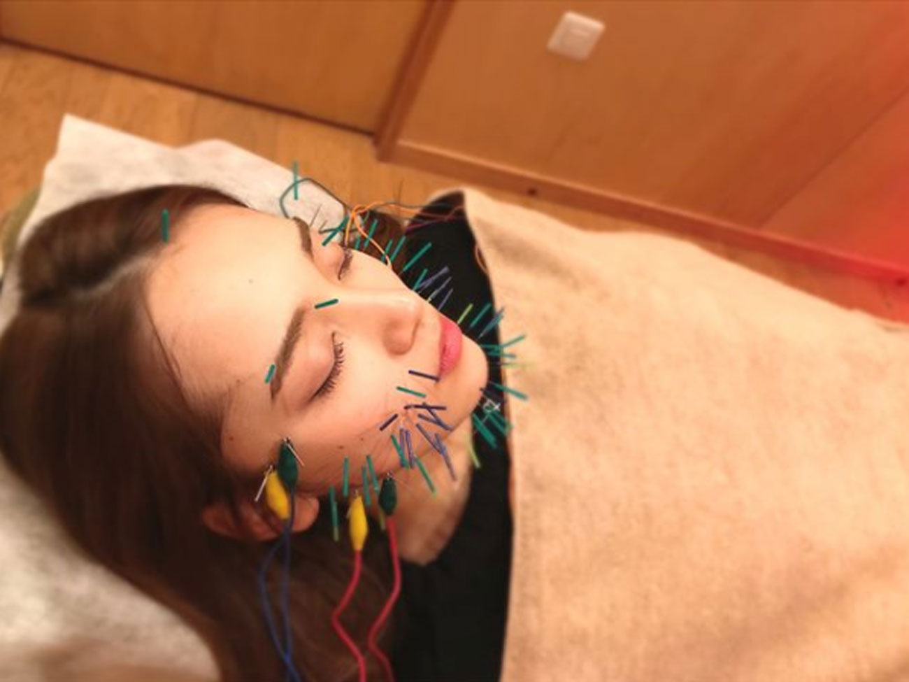 美顔鍼